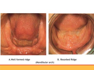 residual ridge resorption seminar final [Autosaved] latest.ppt