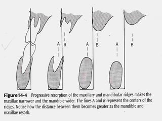residual ridge resorption seminar final [Autosaved] latest.ppt