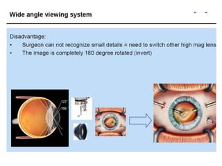 Resight Injection Resight VIUALIZATION SYSTEM FOR RETINAL SURGERY-AJAY DUDANI | PPTX