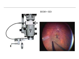 Resight Kit Resight VIUALIZATION SYSTEM FOR RETINAL SURGERY-AJAY DUDANI | PPTX