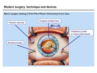 Resight VIUALIZATION SYSTEM FOR RETINAL SURGERY-AJAY DUDANI | PPTX