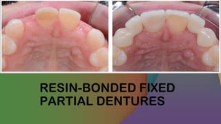 RESIN-BONDED FIXED
PARTIAL DENTURES
 