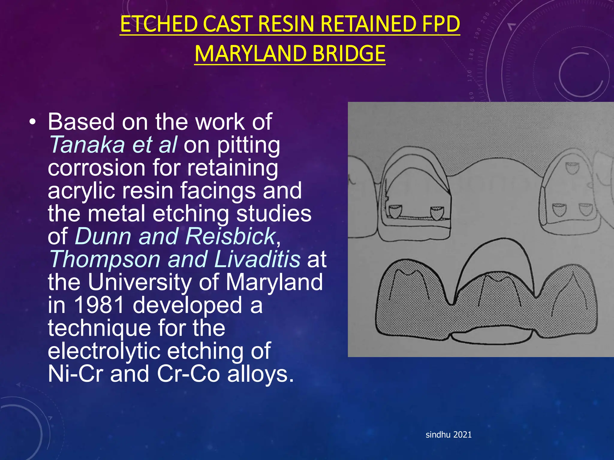 ETCHED CAST RESIN RETAINED FPD
MARYLAND BRIDGE
• Based on the work of
Tanaka et al on pitting
corrosion for retaining
acrylic resin facings and
the metal etching studies
of Dunn and Reisbick,
Thompson and Livaditis at
the University of Maryland
in 1981 developed a
technique for the
electrolytic etching of
Ni-Cr and Cr-Co alloys.
sindhu 2021
 