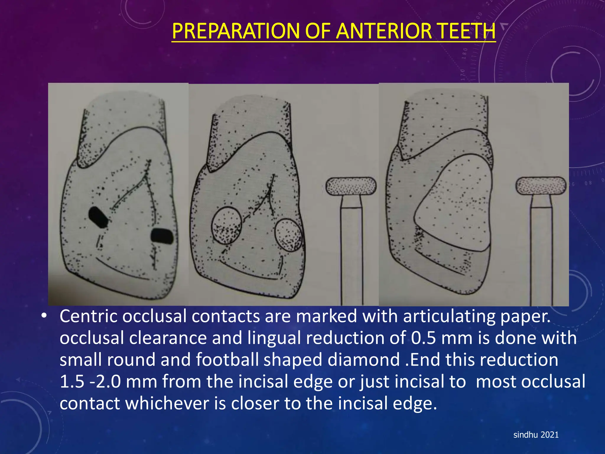 PREPARATION OF ANTERIOR TEETH
• Centric occlusal contacts are marked with articulating paper.
occlusal clearance and lingual reduction of 0.5 mm is done with
small round and football shaped diamond .End this reduction
1.5 -2.0 mm from the incisal edge or just incisal to most occlusal
contact whichever is closer to the incisal edge.
sindhu 2021
 