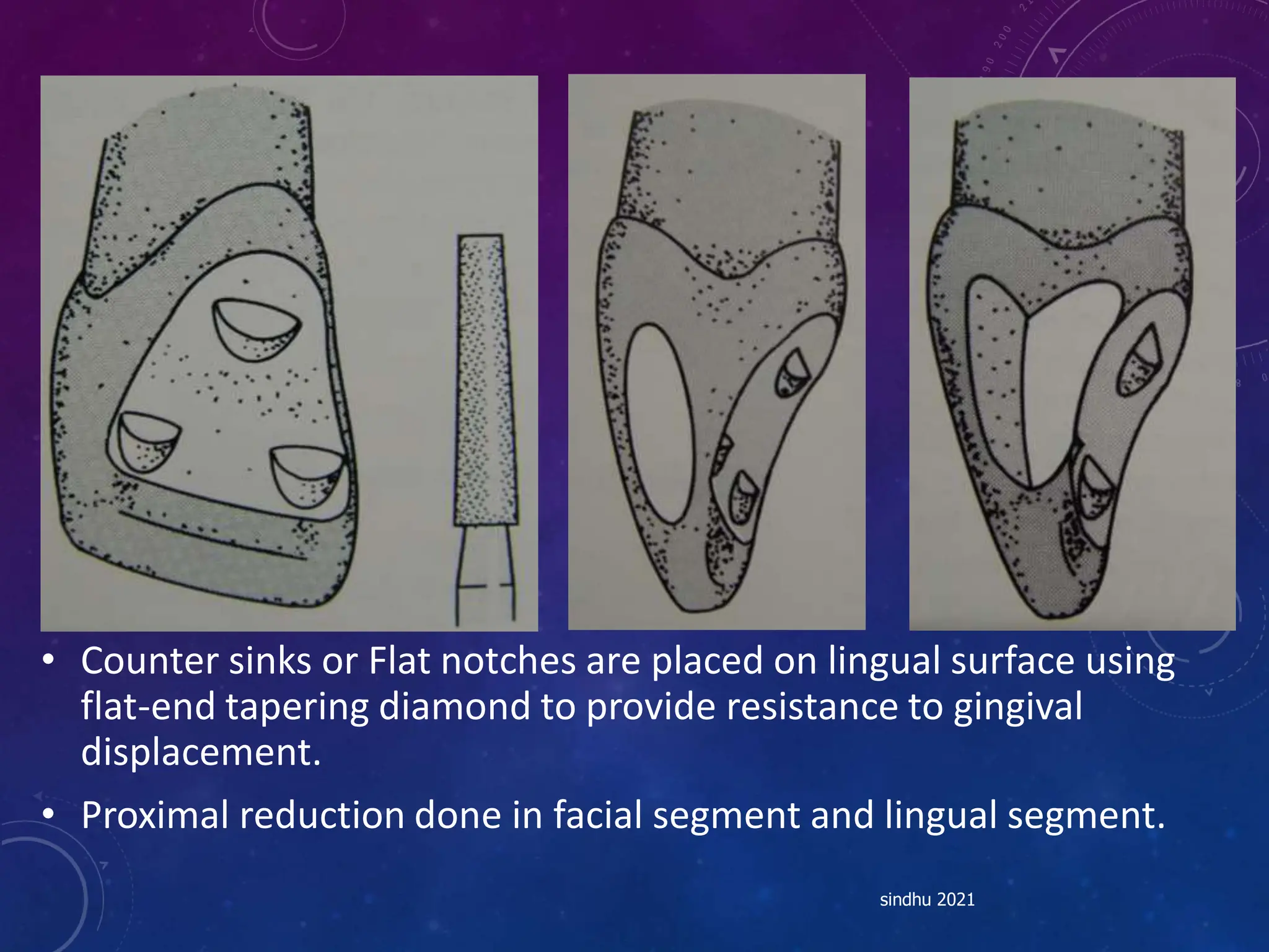 • Counter sinks or Flat notches are placed on lingual surface using
flat-end tapering diamond to provide resistance to gingival
displacement.
• Proximal reduction done in facial segment and lingual segment.
sindhu 2021
 