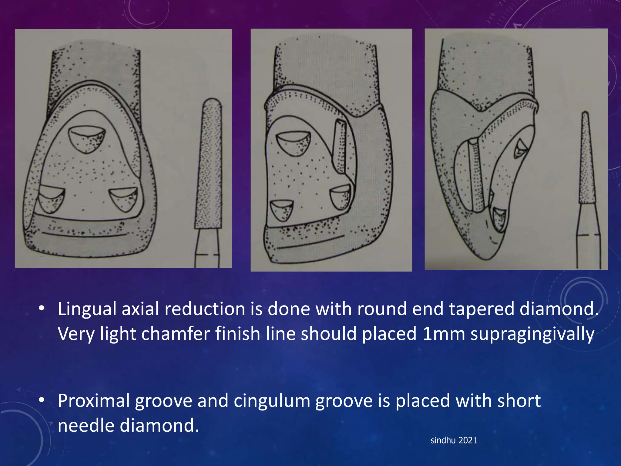 • Lingual axial reduction is done with round end tapered diamond.
Very light chamfer finish line should placed 1mm supragingivally
• Proximal groove and cingulum groove is placed with short
needle diamond.
sindhu 2021
 