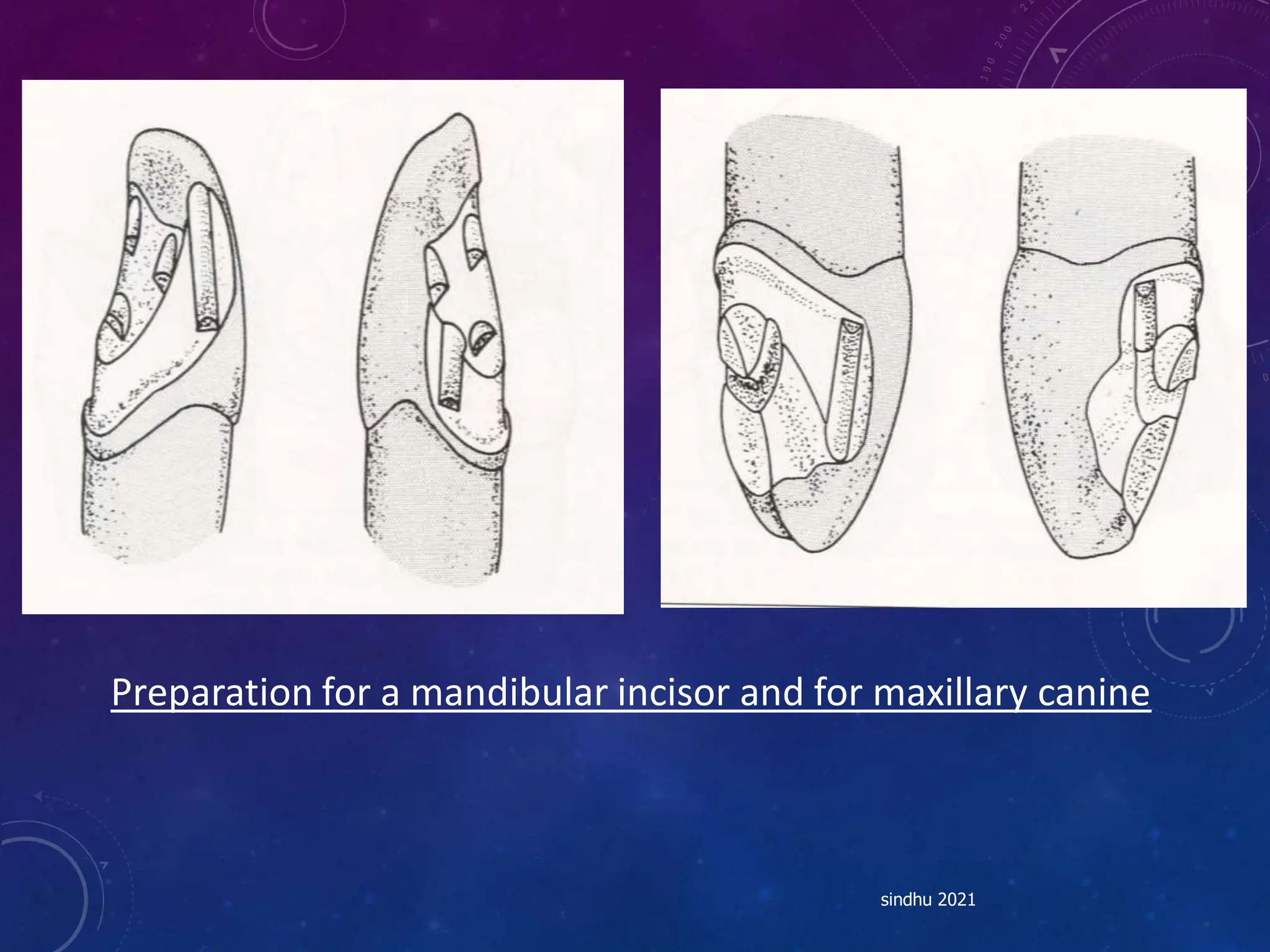 Preparation for a mandibular incisor and for maxillary canine
sindhu 2021
 