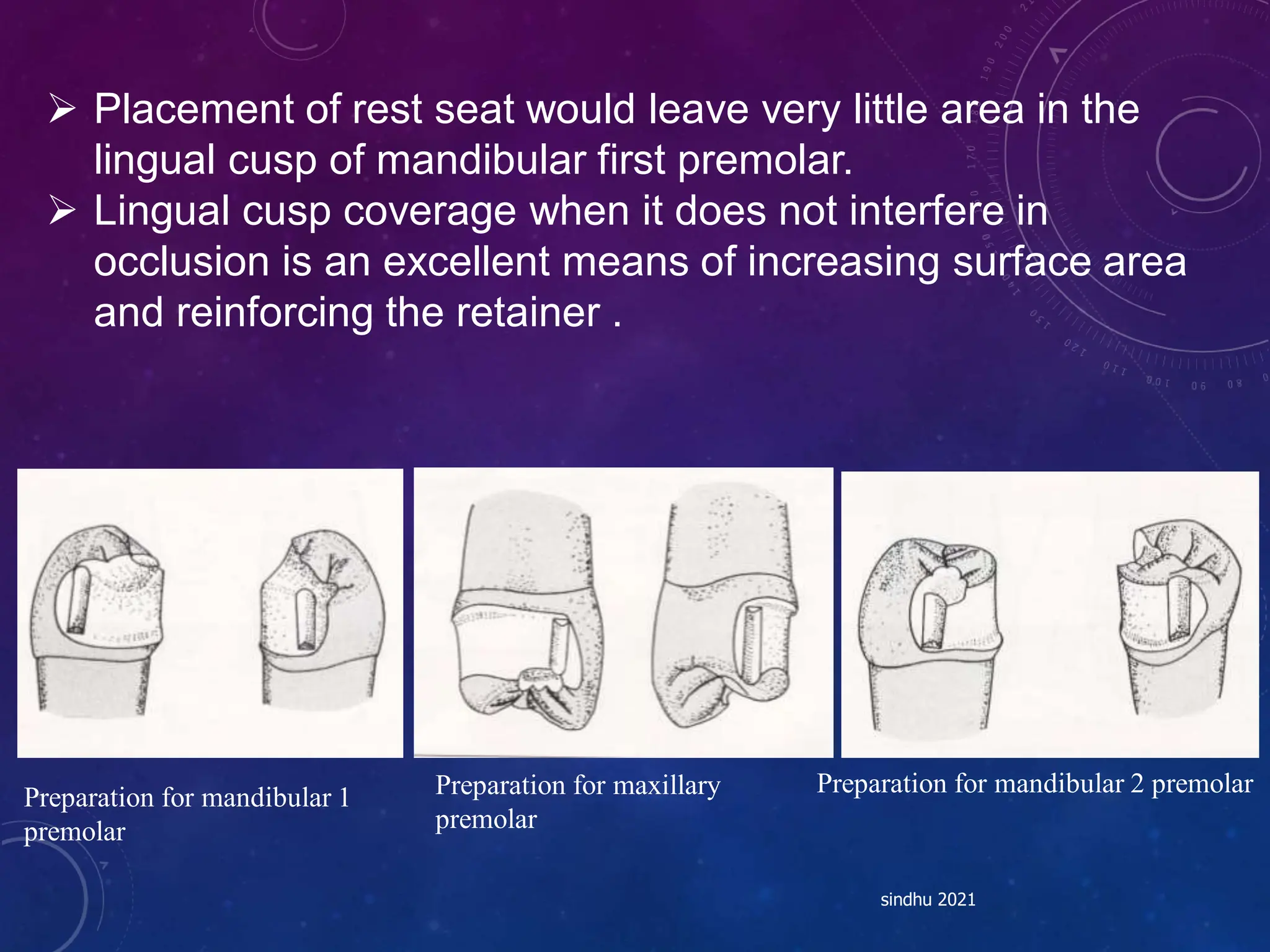 Preparation for maxillary
premolar
Preparation for mandibular 2 premolar
 Placement of rest seat would leave very little area in the
lingual cusp of mandibular first premolar.
 Lingual cusp coverage when it does not interfere in
occlusion is an excellent means of increasing surface area
and reinforcing the retainer .
sindhu 2021
Preparation for mandibular 1
premolar
 