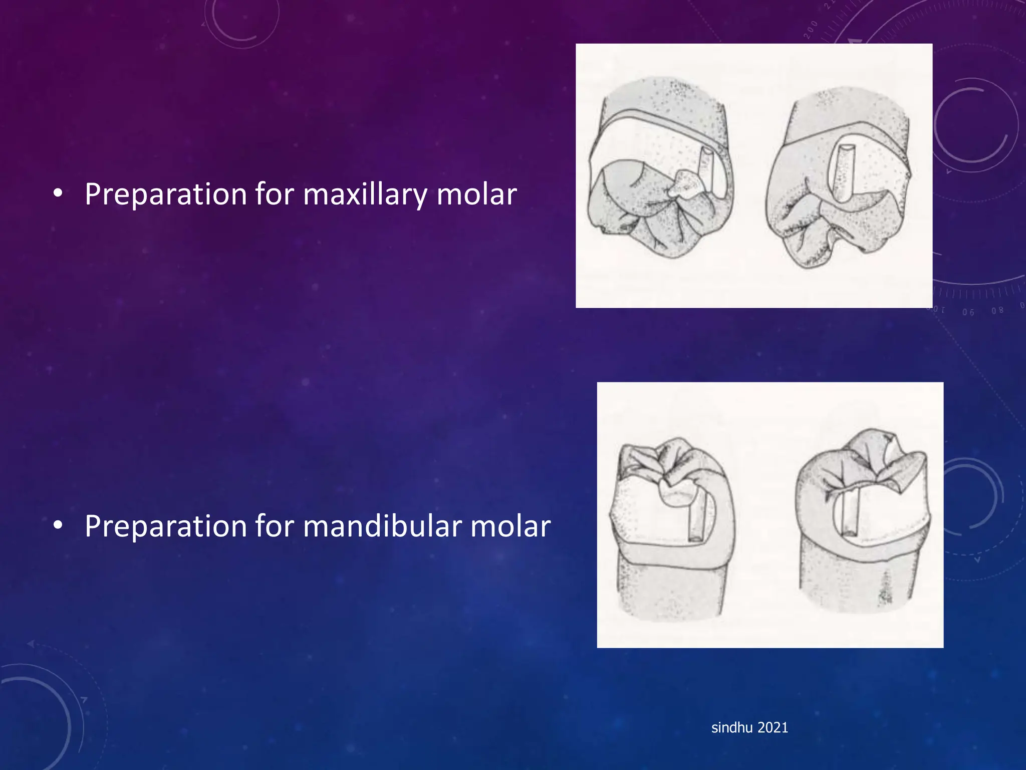 • Preparation for maxillary molar
• Preparation for mandibular molar
sindhu 2021
 