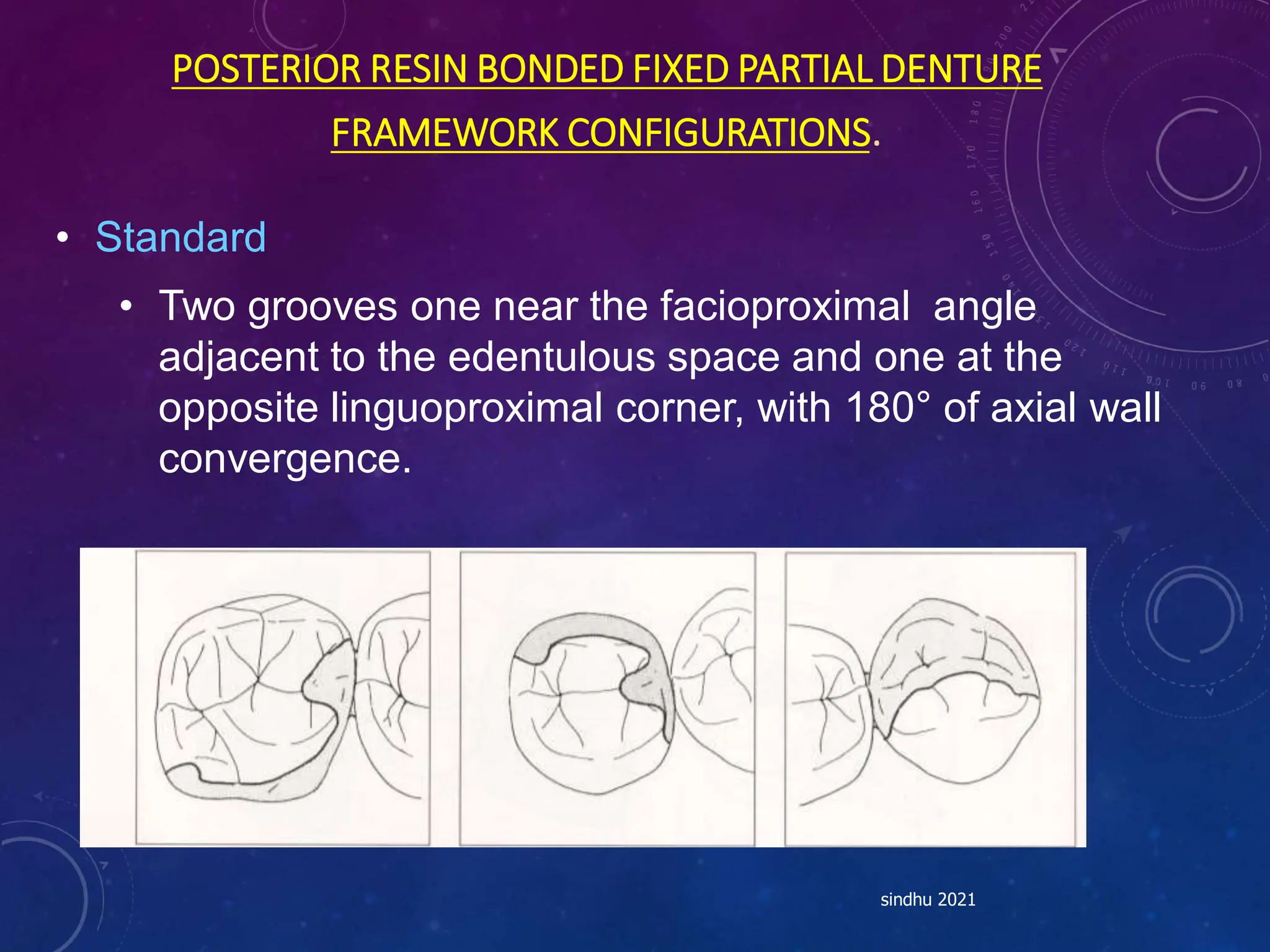 POSTERIOR RESIN BONDED FIXED PARTIAL DENTURE
FRAMEWORK CONFIGURATIONS.
• Standard
• Two grooves one near the facioproximal angle
adjacent to the edentulous space and one at the
opposite linguoproximal corner, with 180° of axial wall
convergence.
sindhu 2021
 