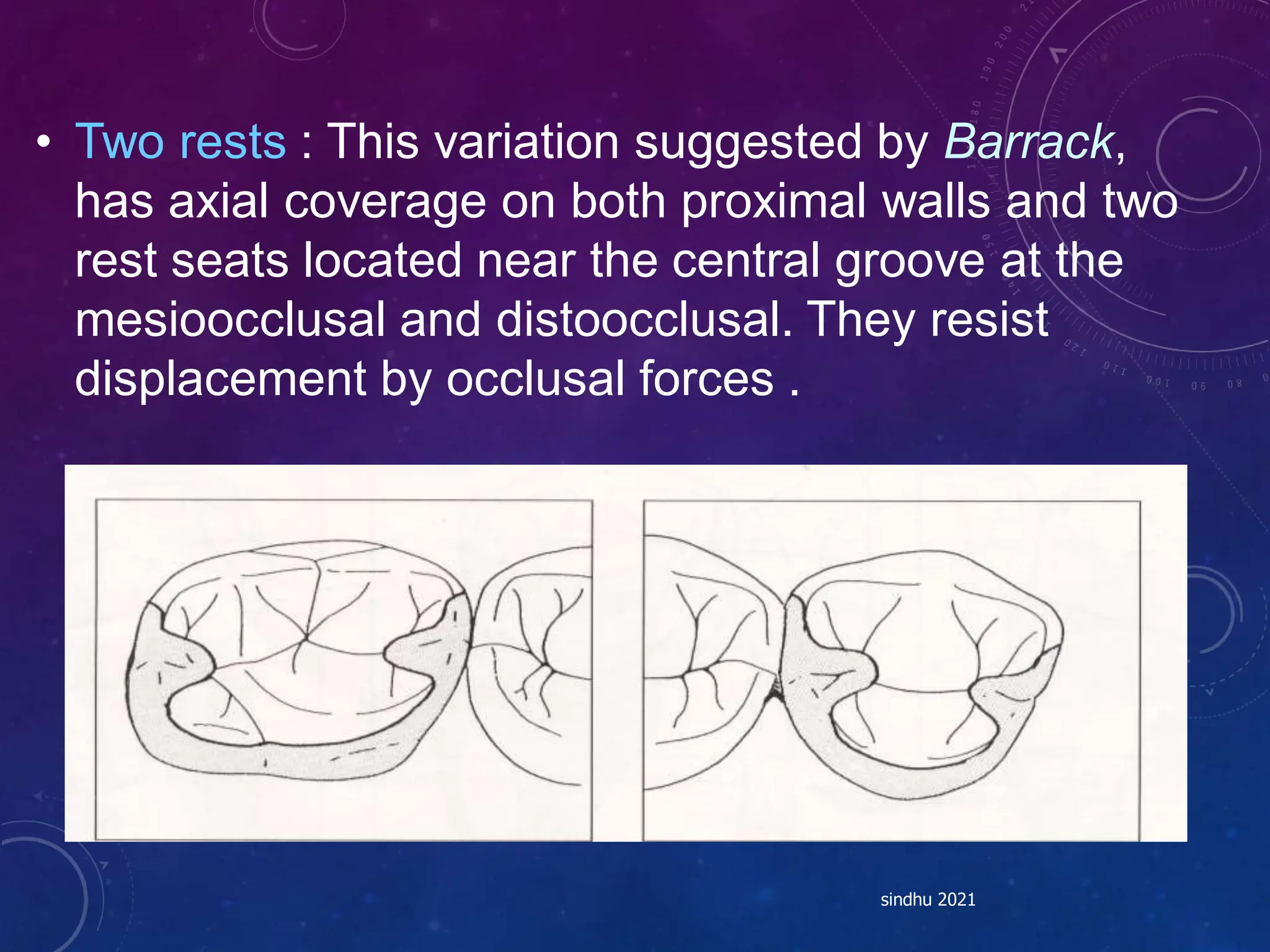 • Two rests : This variation suggested by Barrack,
has axial coverage on both proximal walls and two
rest seats located near the central groove at the
mesioocclusal and distoocclusal. They resist
displacement by occlusal forces .
sindhu 2021
 