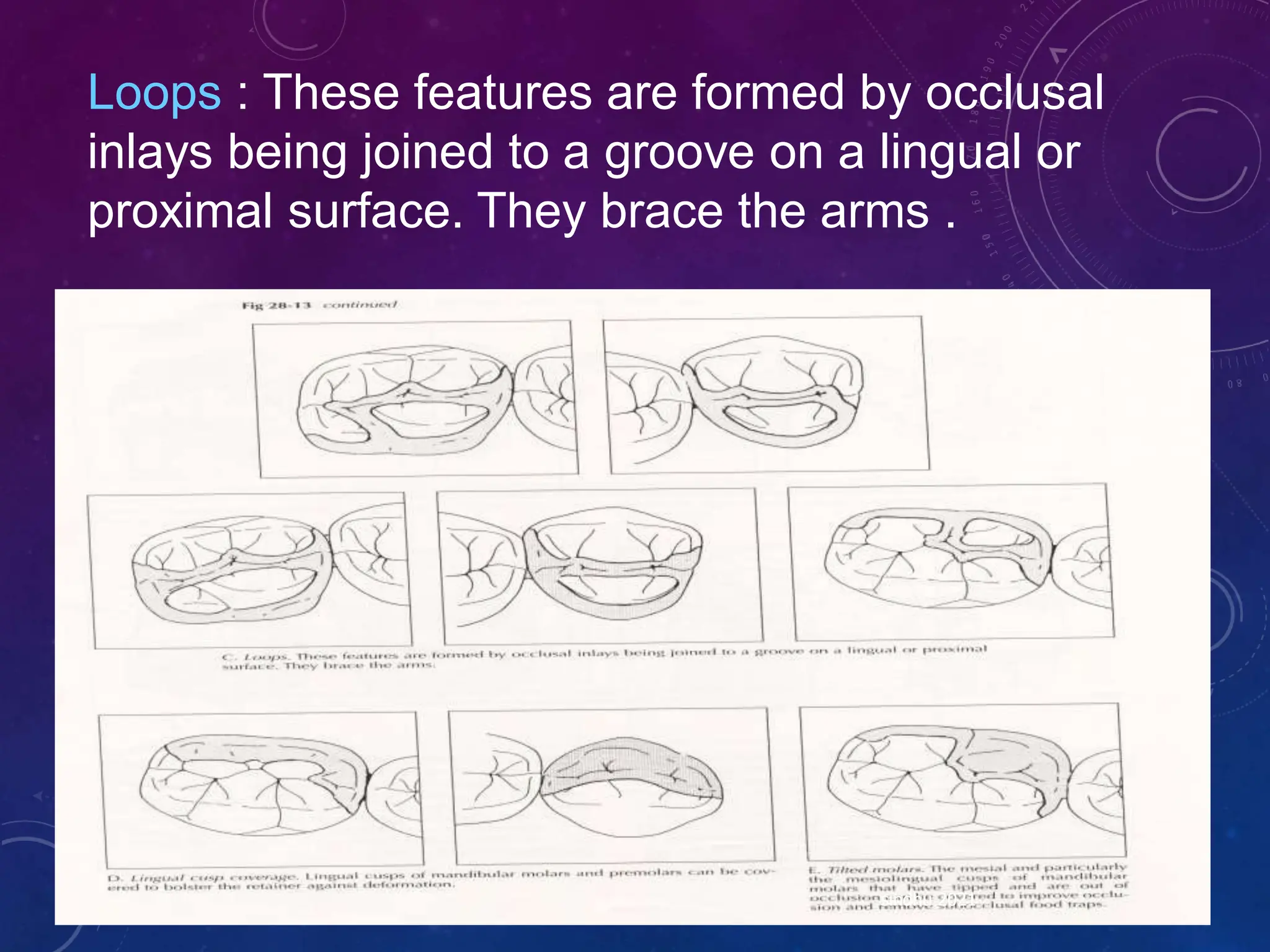 sindhu 2021
Loops : These features are formed by occlusal
inlays being joined to a groove on a lingual or
proximal surface. They brace the arms .
 