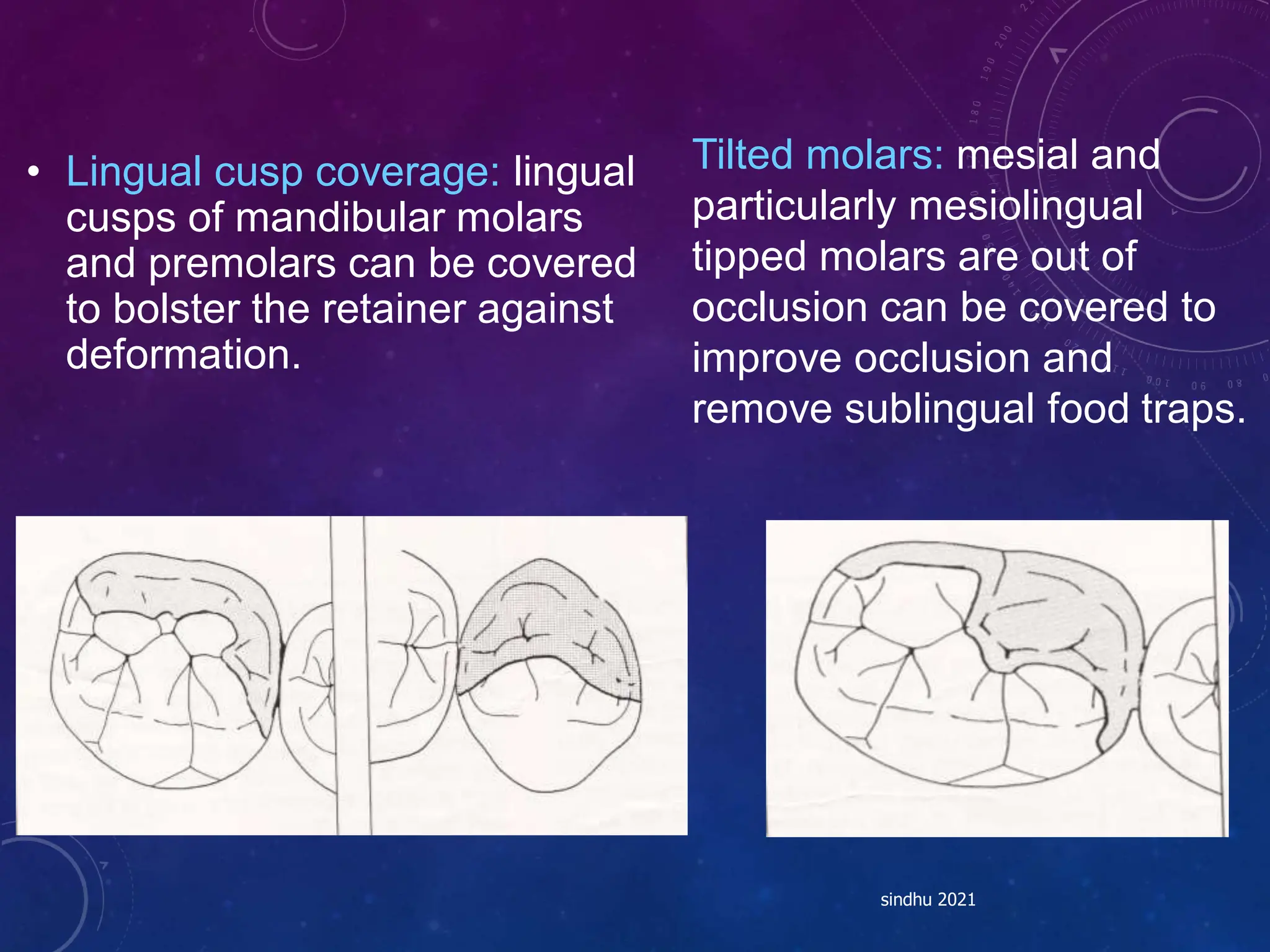• Lingual cusp coverage: lingual
cusps of mandibular molars
and premolars can be covered
to bolster the retainer against
deformation.
sindhu 2021
Tilted molars: mesial and
particularly mesiolingual
tipped molars are out of
occlusion can be covered to
improve occlusion and
remove sublingual food traps.
 