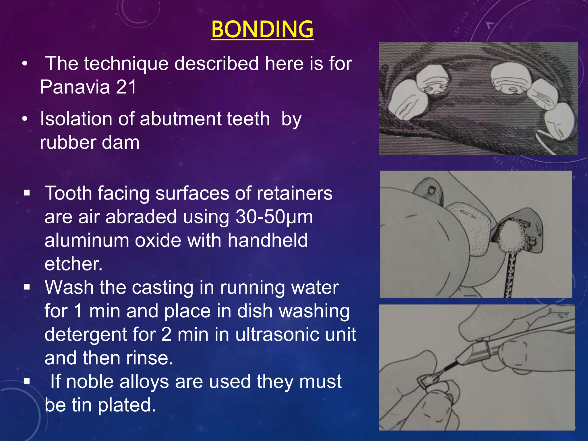 BONDING
• The technique described here is for
Panavia 21
• Isolation of abutment teeth by
rubber dam
sindhu 2021
 Tooth facing surfaces of retainers
are air abraded using 30-50µm
aluminum oxide with handheld
etcher.
 Wash the casting in running water
for 1 min and place in dish washing
detergent for 2 min in ultrasonic unit
and then rinse.
 If noble alloys are used they must
be tin plated.
 