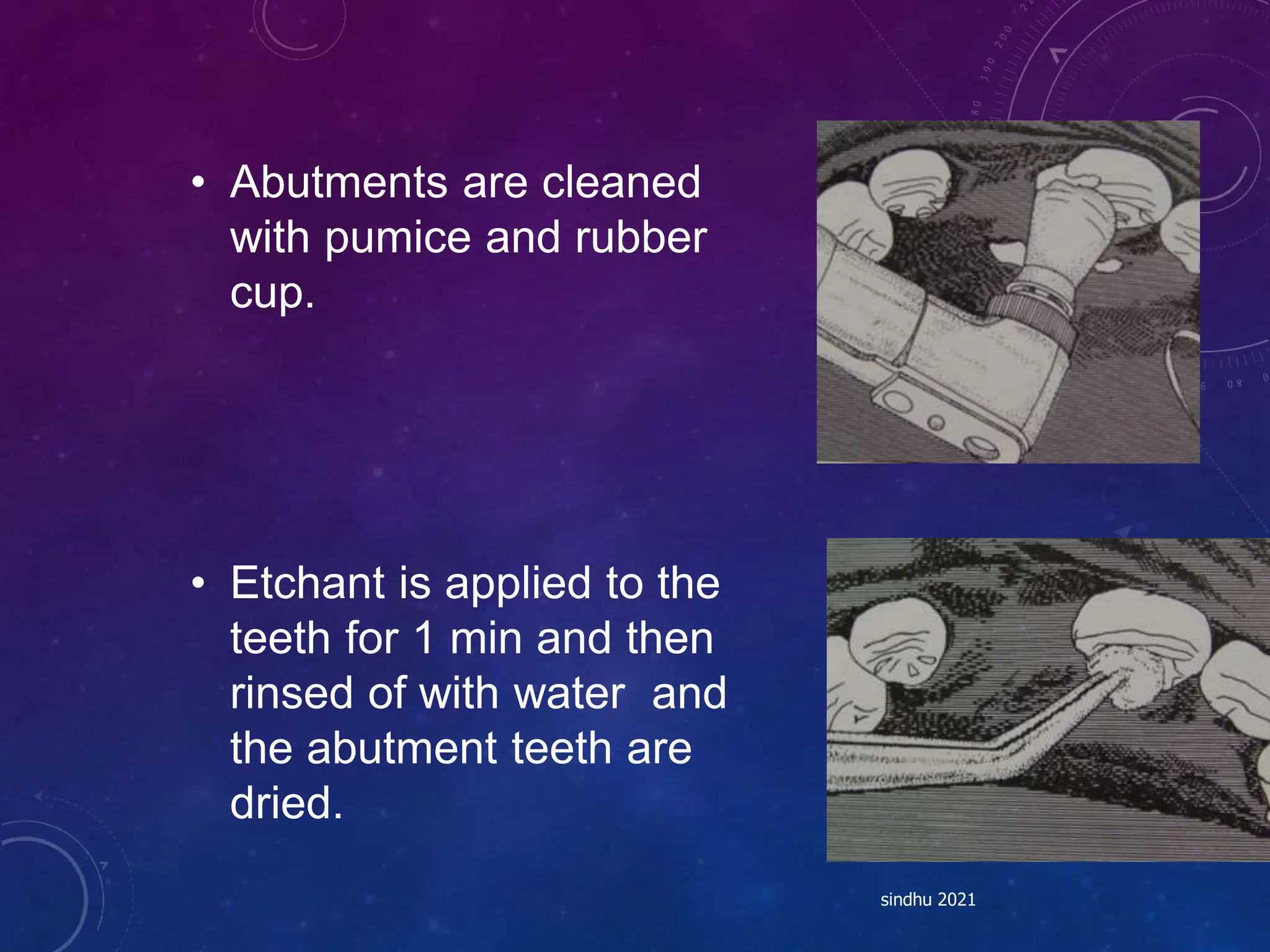 • Abutments are cleaned
with pumice and rubber
cup.
• Etchant is applied to the
teeth for 1 min and then
rinsed of with water and
the abutment teeth are
dried.
sindhu 2021
 