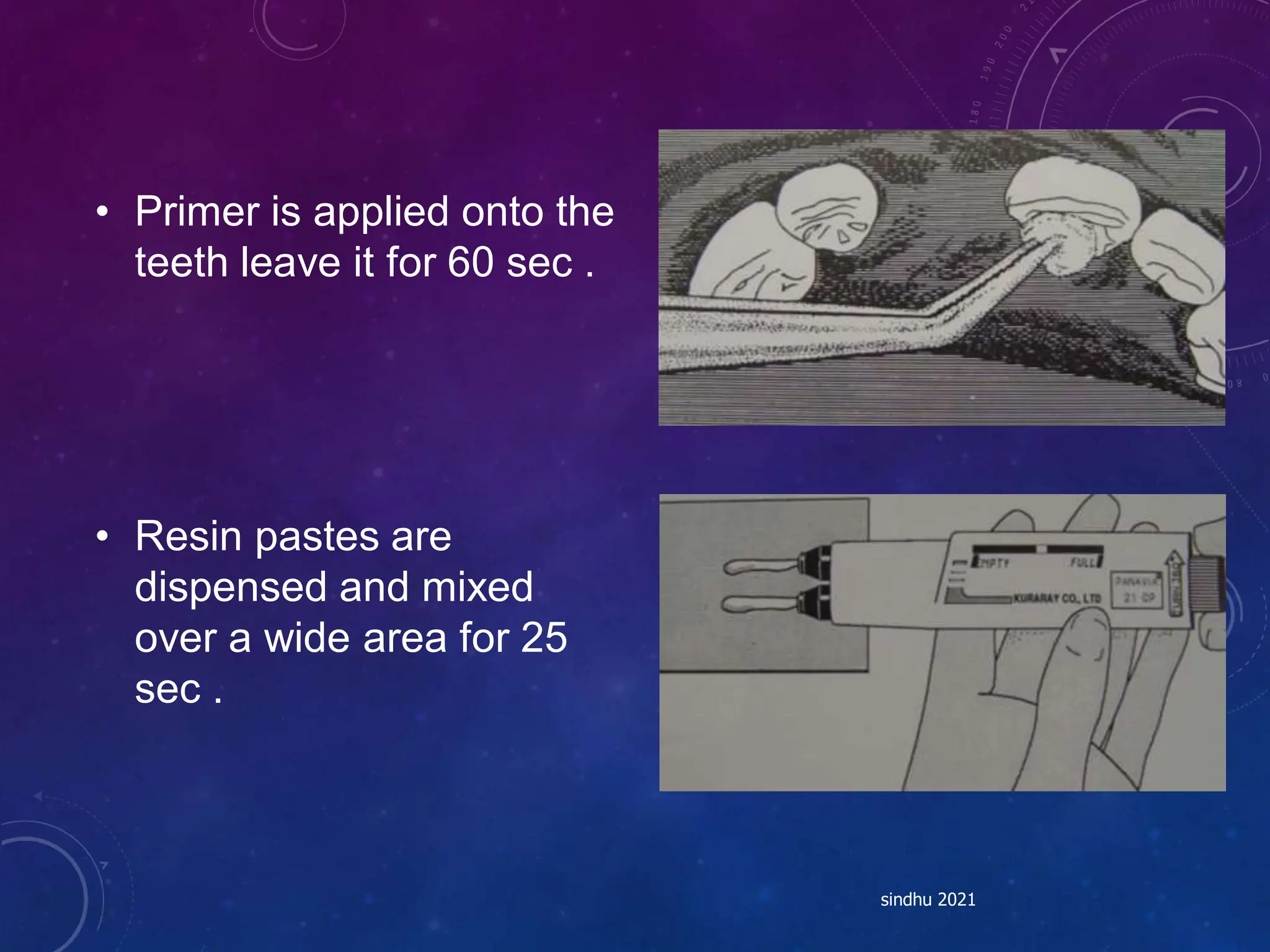 • Primer is applied onto the
teeth leave it for 60 sec .
• Resin pastes are
dispensed and mixed
over a wide area for 25
sec .
sindhu 2021
 