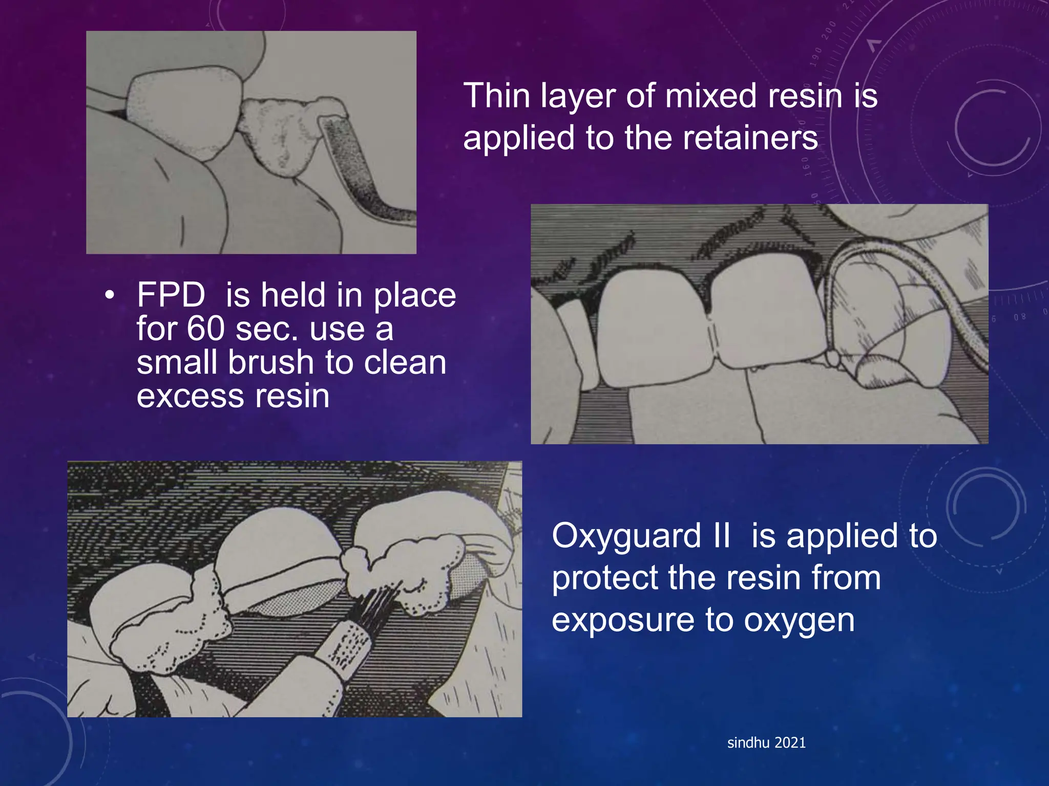 • FPD is held in place
for 60 sec. use a
small brush to clean
excess resin
sindhu 2021
Thin layer of mixed resin is
applied to the retainers
Oxyguard II is applied to
protect the resin from
exposure to oxygen
 