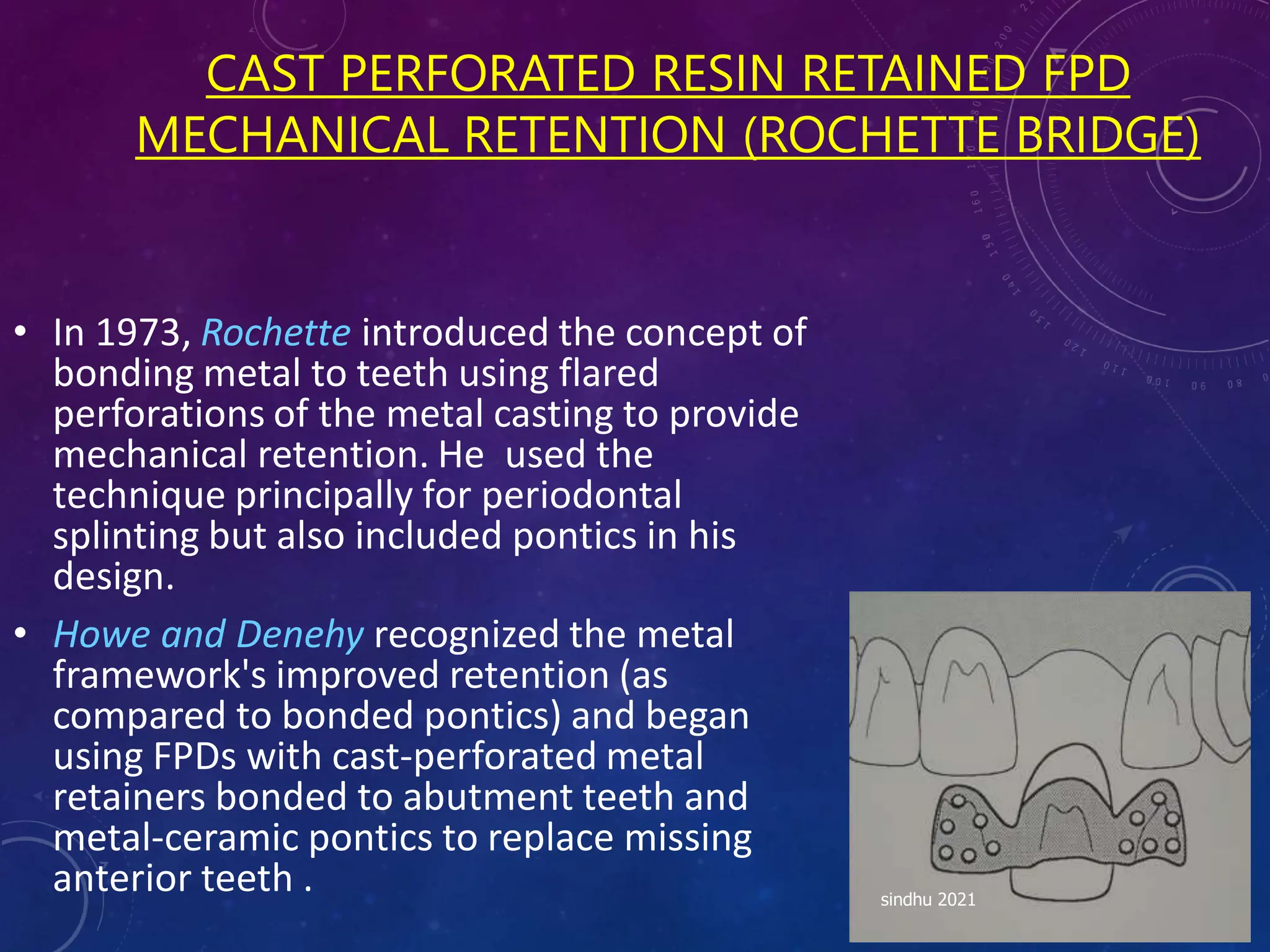 CAST PERFORATED RESIN RETAINED FPD
MECHANICAL RETENTION (ROCHETTE BRIDGE)
• In 1973, Rochette introduced the concept of
bonding metal to teeth using flared
perforations of the metal casting to provide
mechanical retention. He used the
technique principally for periodontal
splinting but also included pontics in his
design.
• Howe and Denehy recognized the metal
framework's improved retention (as
compared to bonded pontics) and began
using FPDs with cast-perforated metal
retainers bonded to abutment teeth and
metal-ceramic pontics to replace missing
anterior teeth . sindhu 2021
 