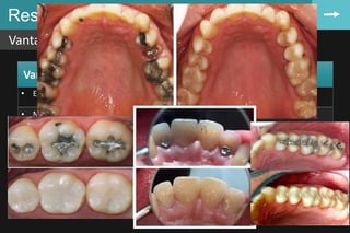 Resina composta
Vantagens e desvantagens
86
• Estético;
• Não apresenta toxicidade;
• O fato de o preparo cavitário poder ser executado com mínimo sacrifício de
estrutura dental sadia;
• Menor corrosão;
• A restauração pode ser concluída em uma única sessão;
Vantagens das resinas em relação ao amálgama
 