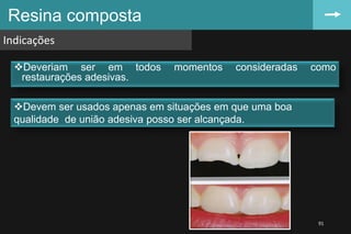 Deveriam ser em todos momentos consideradas como
restaurações adesivas.
Resina composta
Indicações
91
Devem ser usados apenas em situações em que uma boa
qualidade de união adesiva posso ser alcançada.
 
