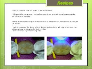 •Aplique un ácido fosfórico como sobre el composite.
•Enjuague bien y seque muy bien aplicando primero un imprimidor y luego secando
agresivamente con aire.
•PrimaDry removerá cualquier humedad residual esto mejora la penetración del sellante
de resinas.
•Aplique una capa fina de un sellante de composites , luego afine agresivamente con
aire para llevar la resina dentro de las grietas.
• Fotocure cada superficie 20 segundos.
 
