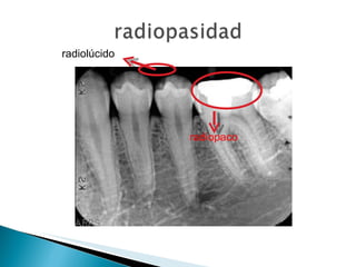 radiopaco radiolúcido 