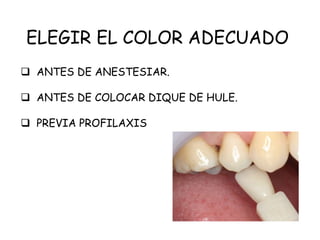 ELEGIR EL COLOR ADECUADO
 ANTES DE ANESTESIAR.
 ANTES DE COLOCAR DIQUE DE HULE.
 PREVIA PROFILAXIS
 