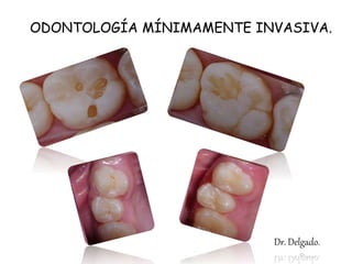 ODONTOLOGÍA MÍNIMAMENTE INVASIVA.
Dr. Delgado.
 