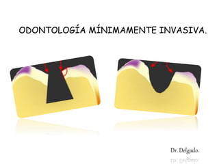 ODONTOLOGÍA MÍNIMAMENTE INVASIVA.
Dr. Delgado.
 