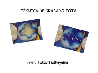 TÉCNICA DE GRABADO TOTAL.
Prof. Takao Fushayama
 