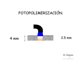 4 mm
FOTOPOLIMERIZACIÓN.
2.5 mm
Dr. Delgado.
 