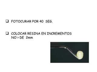 FOTOCURAR POR 40 SEG.
 COLOCAR RESINA EN INCREMENTOS
NO > DE 2mm
 
