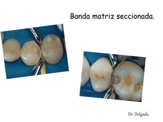 Banda matriz seccionada.
Dr. Delgado.
 