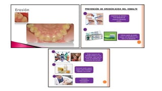 RESINAS_COMPUESTAS[1].pdffwseeeeeeeeeeeeeeeeeee