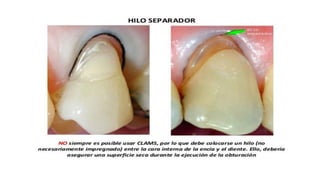 RESINAS_COMPUESTAS[1].pdffwseeeeeeeeeeeeeeeeeee