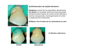 RESINAS_COMPUESTAS[1].pdffwseeeeeeeeeeeeeeeeeee