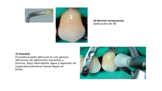 RESINAS_COMPUESTAS[1].pdffwseeeeeeeeeeeeeeeeeee