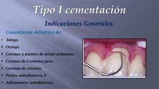 Tipo I cementación
Indicaciones Generales:
Cementación definitiva de:
▪ Inlays.
▪ Onlays.
▪ Coronas y puentes de metal-cerámicas.
▪ Coronas de Cerámica pura.
▪ Coronas de zirconio.
▪ Postes endodónticos. Y
▪ Aditamentos ortodónticos.
 