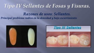 Tipo IV Sellantes de Fosas y Fisuras.
Razones de usos: Sellantes.
Principal problema radica en la densidad y bajo escurrimiento
 