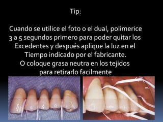 Tip:
Cuando se utilice el foto o el dual, polimerice
3 a 5 segundos primero para poder quitar los
Excedentes y después aplique la luz en el
Tiempo indicado por el fabricante.
O coloque grasa neutra en los tejidos
para retirarlo facilmente
 
