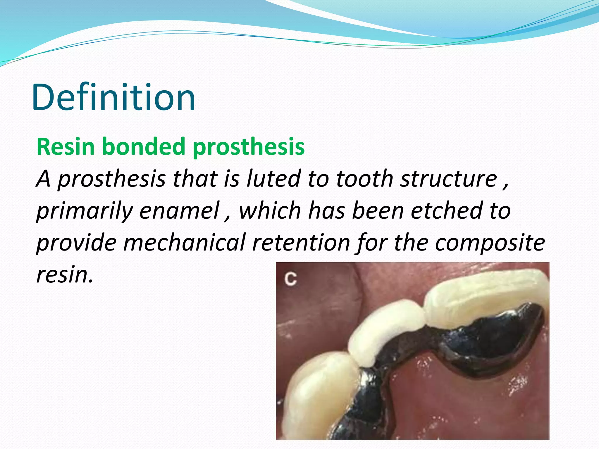 TYPES OF RESIN BONDED FIXED PARTIAL DENTURE visual data 5