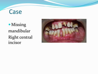 Case
 Missing
mandibular
Right central
incisor
 