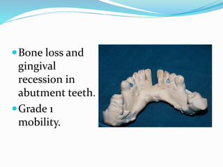 Bone loss and
gingival
recession in
abutment teeth.
Grade 1
mobility.
 