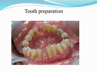 Tooth preparation
 