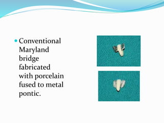  Conventional
Maryland
bridge
fabricated
with porcelain
fused to metal
pontic.
 