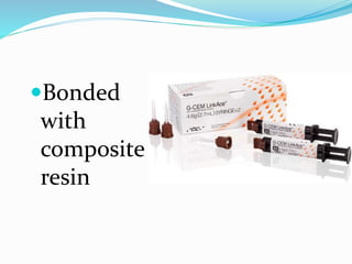 Bonded
with
composite
resin
 