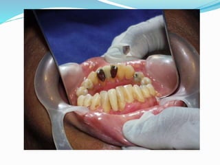 Resin bonded fixed partial denture