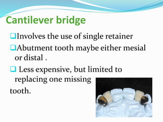 Cantilever bridge
Involves the use of single retainer
Abutment tooth maybe either mesial
or distal .
 Less expensive, but limited to
replacing one missing
tooth.
 