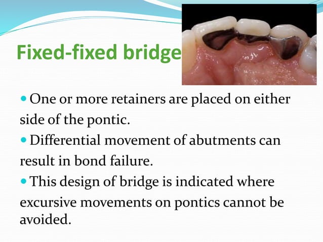 TYPES OF RESIN BONDED FIXED PARTIAL DENTURE visual data 2
