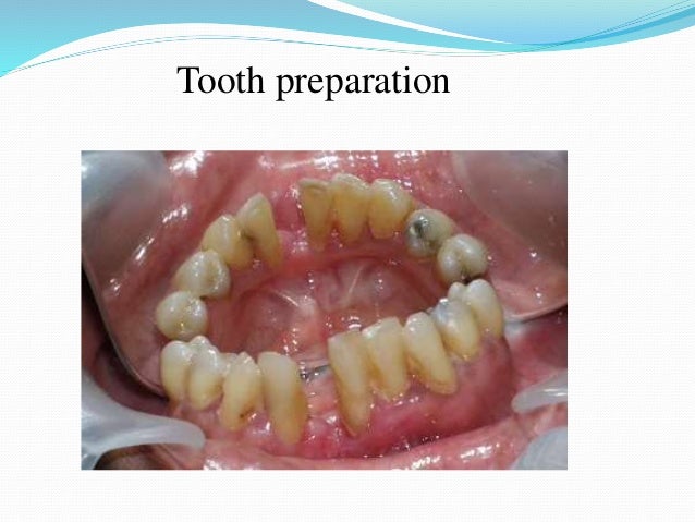 Resin Bonded Fixed Partial Denture